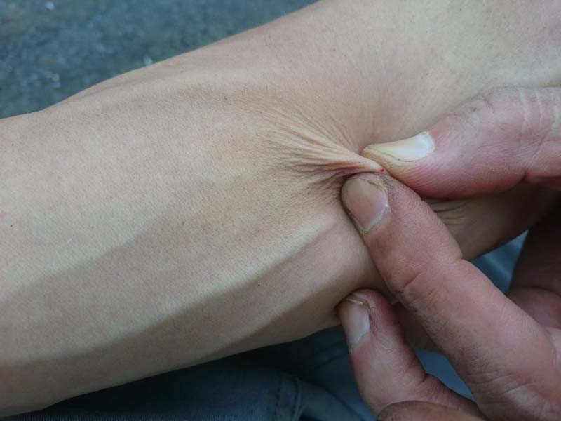 足 切断 ブヨ 蚊やブヨの虫刺され、ナメると危険！掻くのは絶対NG！皮膚炎が全身に広がり治療困難も
